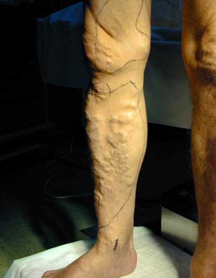  Patolog�a de las varices